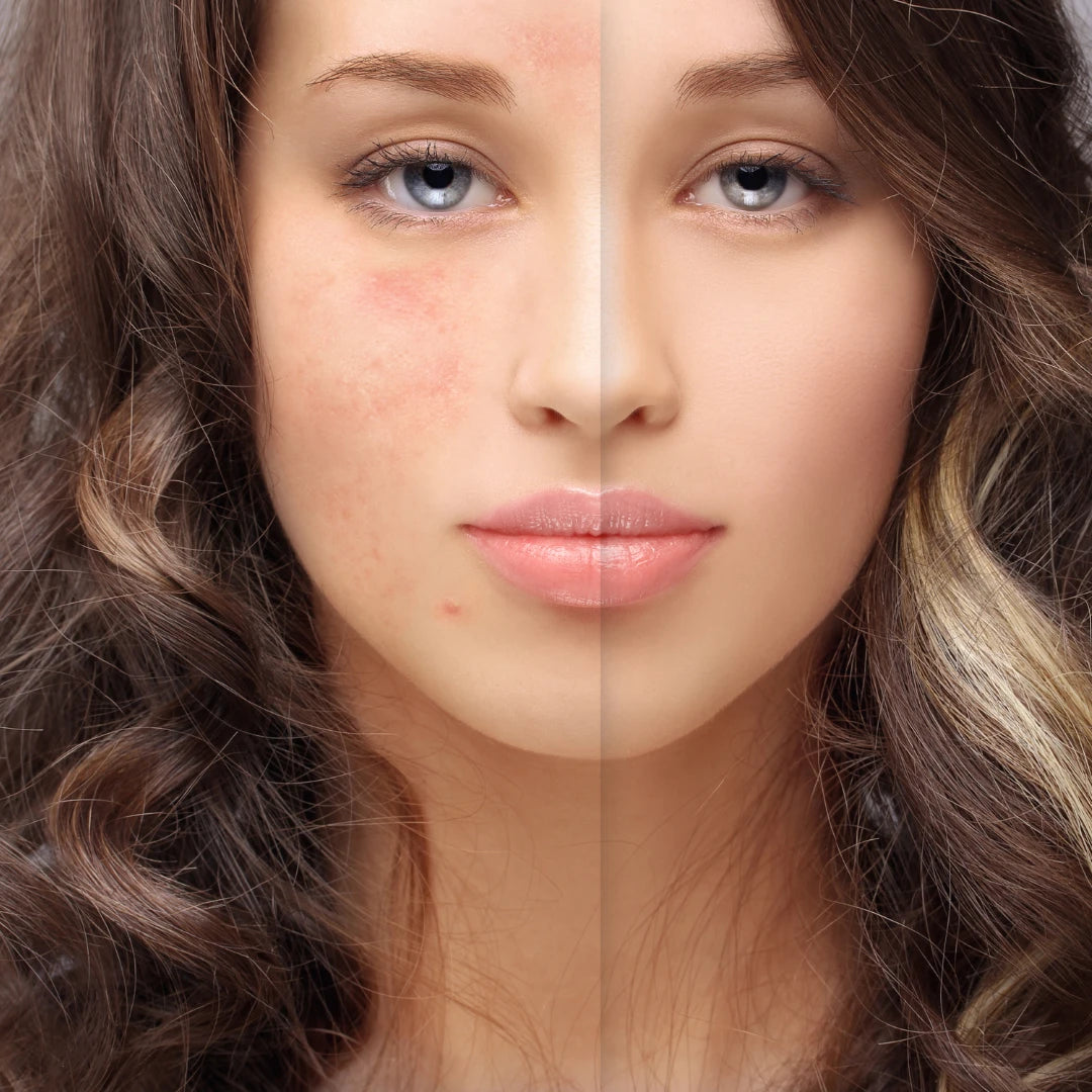 before and after , acne treatment 